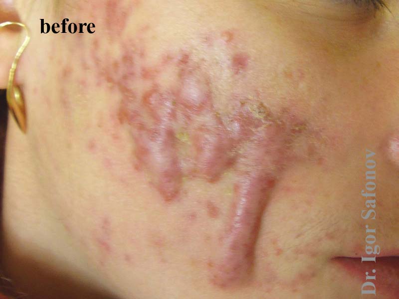 Келоидные рубцы на лице после акне до лечения (акне-келоиды)
