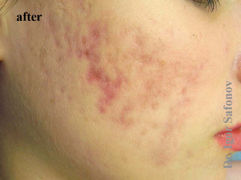 [:ru]келоидные рубцы на лице после акне после лечения[:]