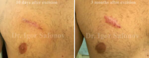 [:ru]фото рецидив келоидного рубца на грудной клетке после операции[:]