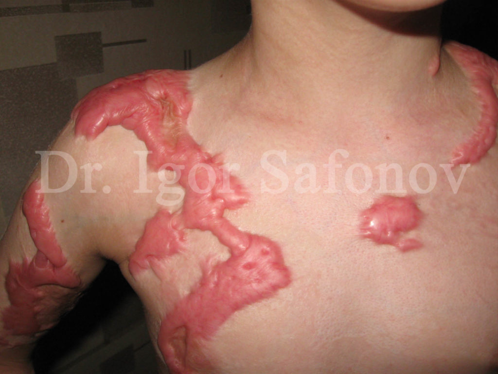 Лечение послеоперационных рубцов кожи