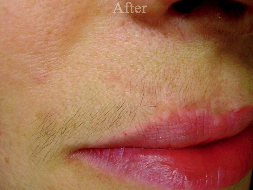 Атрофічний рубець у ділянці верхньої губи після лікування. Дно рубця зрівнялося з краями і на рівні навколишньої шкіри