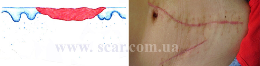 Схематичне зображення і фото нормотрофічних рубців на животі. Свіжі нормотрофічні рубці після операції врівень зі шкірою